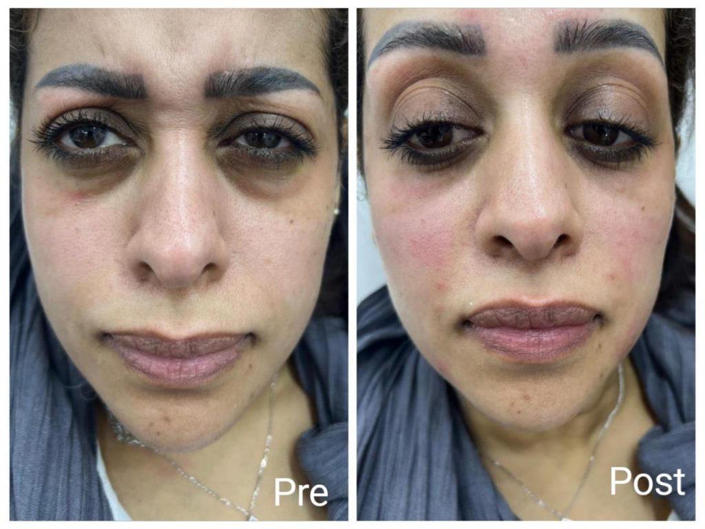 Preliminary result after the first profile session